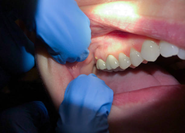 Best Emergency Dentist for Lost Fillings or Crowns in Cedar Bluff, VA